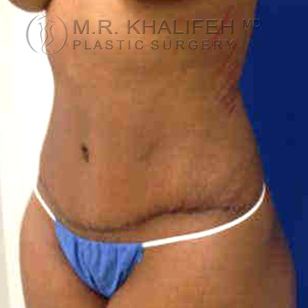 Tummy Tuck Gallery - Patient 3762152 - Image 10