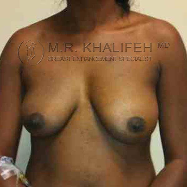 Breast Augmentation Gallery - Patient 3762154 - Image 1