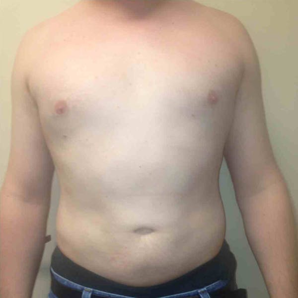 Male Liposuction Gallery - Patient 3762159 - Image 4