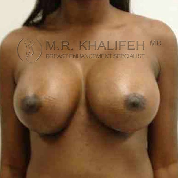 Breast Augmentation Gallery - Patient 3762154 - Image 2