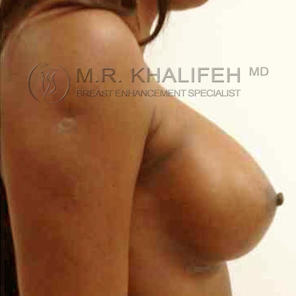 Breast Augmentation Gallery - Patient 3762154 - Image 4