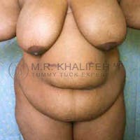 Tummy Tuck Gallery - Patient 3762161 - Image 1