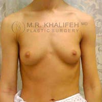 Breast Augmentation Gallery - Patient 3762165 - Image 1
