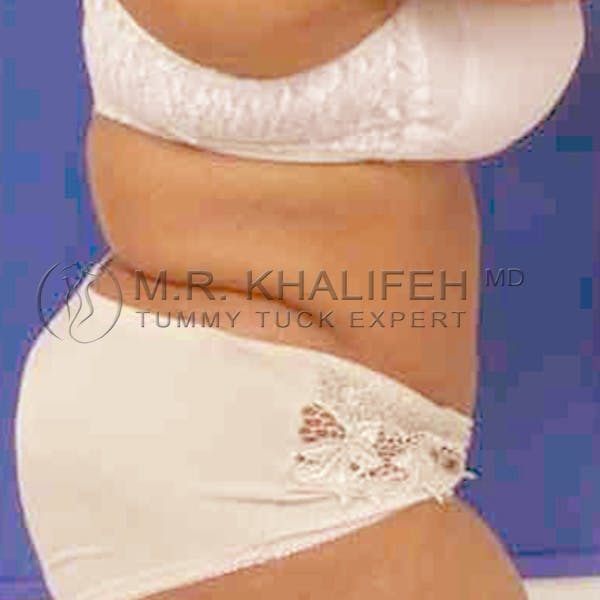 Tummy Tuck Gallery - Patient 3762161 - Image 4