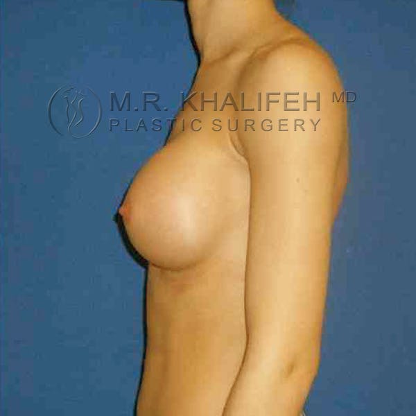 Breast Augmentation Gallery - Patient 3762165 - Image 6
