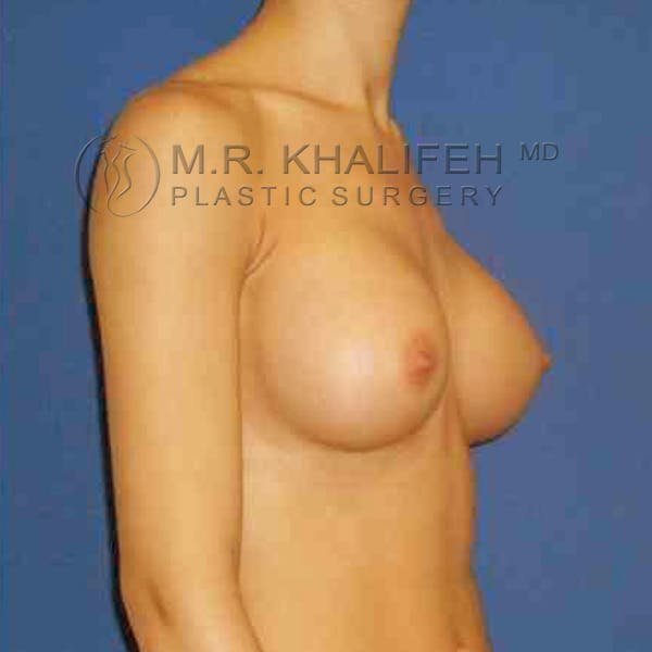 Breast Augmentation Gallery - Patient 3762165 - Image 8