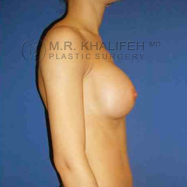 Breast Augmentation Gallery - Patient 3762165 - Image 10