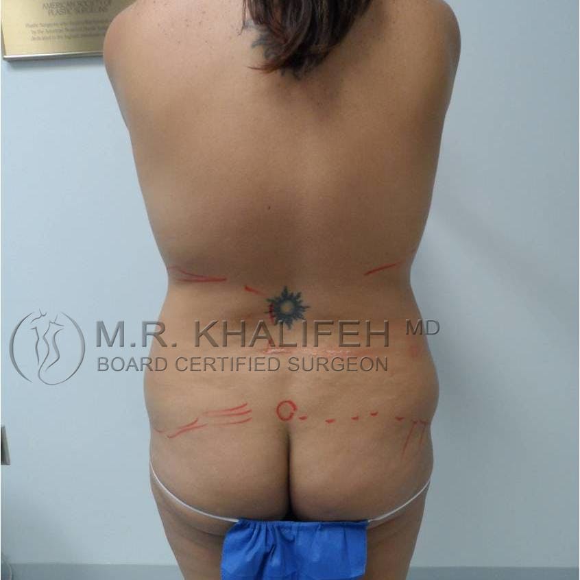 Tummy Tuck Gallery - Patient 3762172 - Image 3