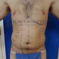 Male Liposuction Gallery - Patient 3762168 - Image 1