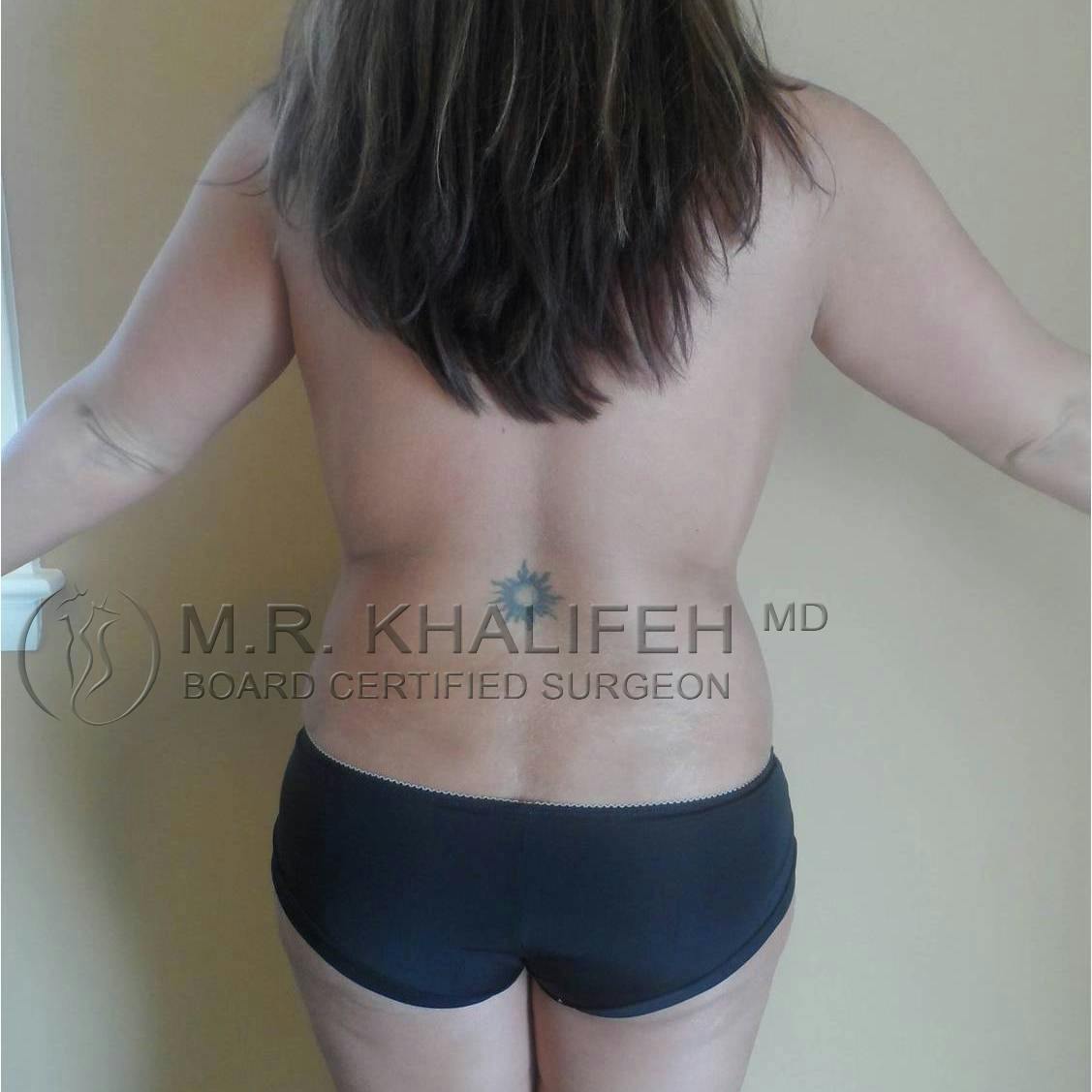 Tummy Tuck Gallery - Patient 3762172 - Image 4