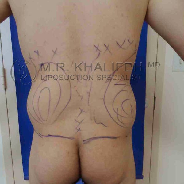 Male Liposuction Gallery - Patient 3762168 - Image 3