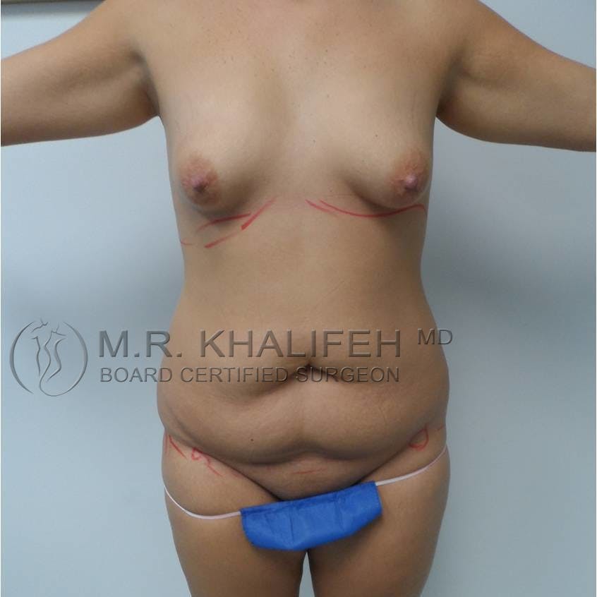 Tummy Tuck Gallery - Patient 3762172 - Image 1