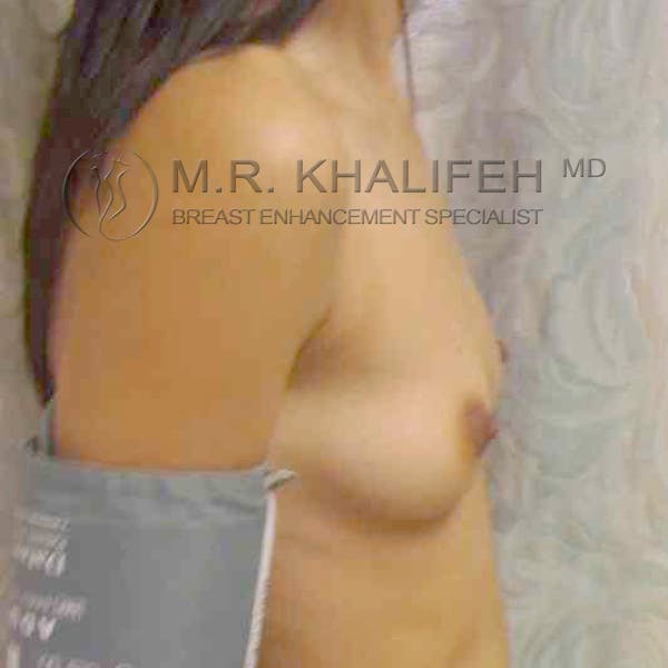 Breast Augmentation Gallery - Patient 3762171 - Image 3