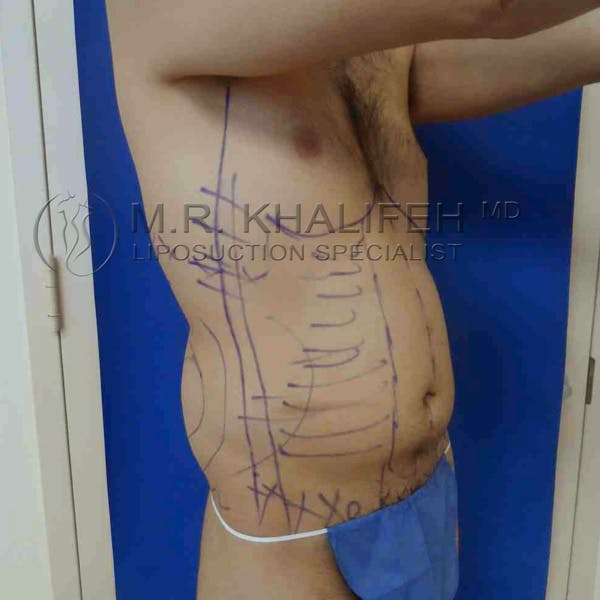Male Liposuction Gallery - Patient 3762168 - Image 5