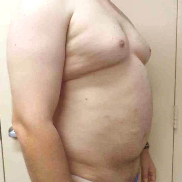 Male Liposuction Gallery - Patient 3762181 - Image 5