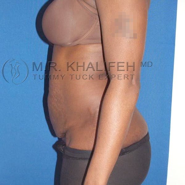 Tummy Tuck Gallery - Patient 3762187 - Image 1