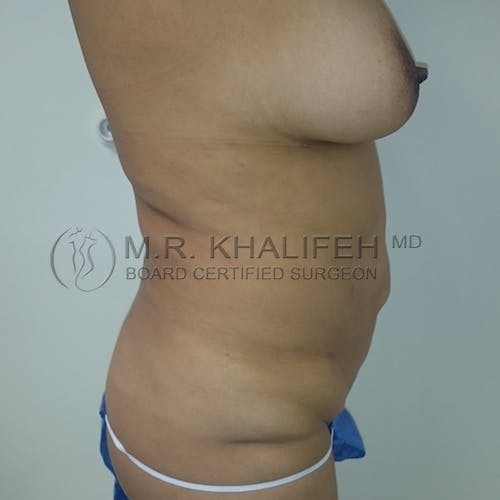 Breast Lift Gallery - Patient 3762185 - Image 3