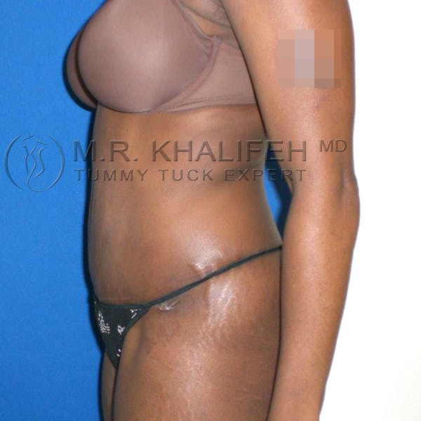 Tummy Tuck Gallery - Patient 3762187 - Image 2