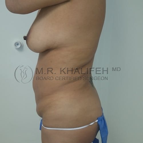 Breast Lift Gallery - Patient 3762185 - Image 5