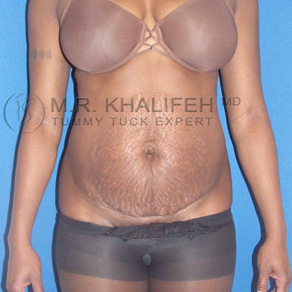 Tummy Tuck Gallery - Patient 3762187 - Image 3