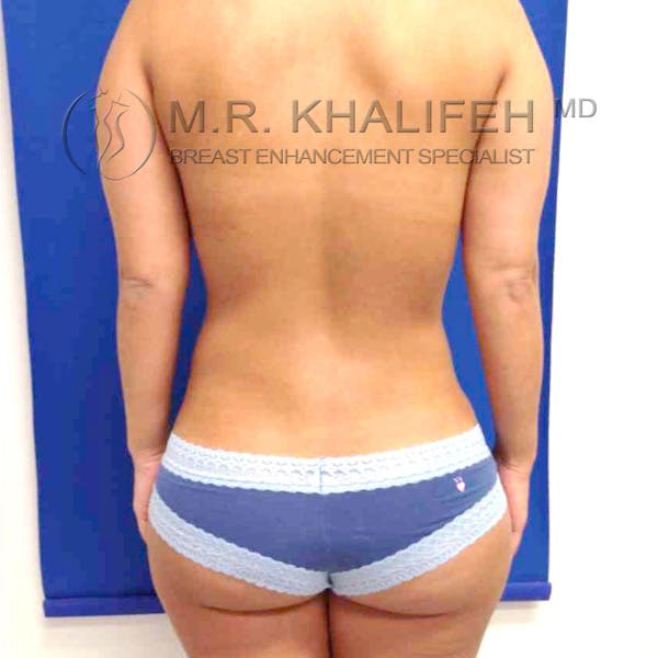Breast Augmentation Gallery - Patient 3762184 - Image 4