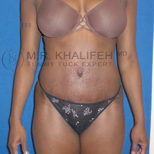 Tummy Tuck Gallery - Patient 3762187 - Image 4