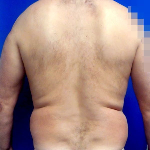 Male Liposuction Gallery - Patient 3762203 - Image 1