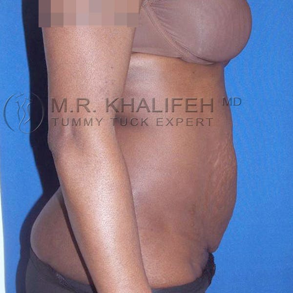 Tummy Tuck Gallery - Patient 3762187 - Image 5