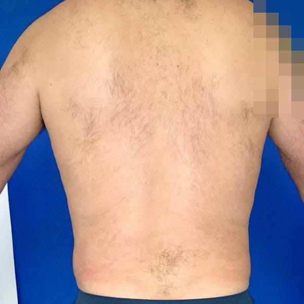 Male Liposuction Gallery - Patient 3762203 - Image 2