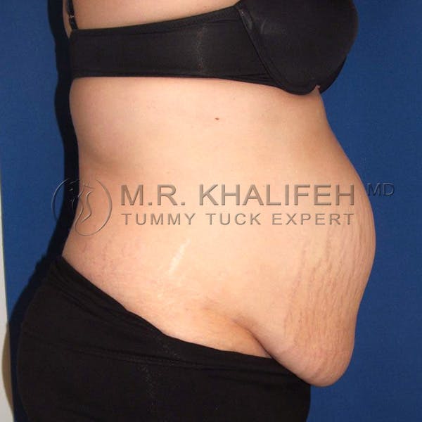 Tummy Tuck Gallery - Patient 3762202 - Image 3