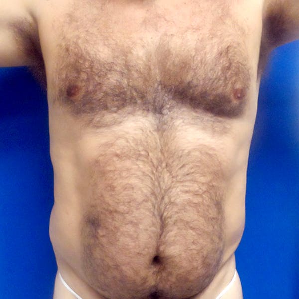 Male Liposuction Gallery - Patient 3762203 - Image 5