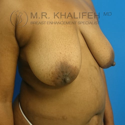 Breast Lift Gallery - Patient 3762196 - Image 3