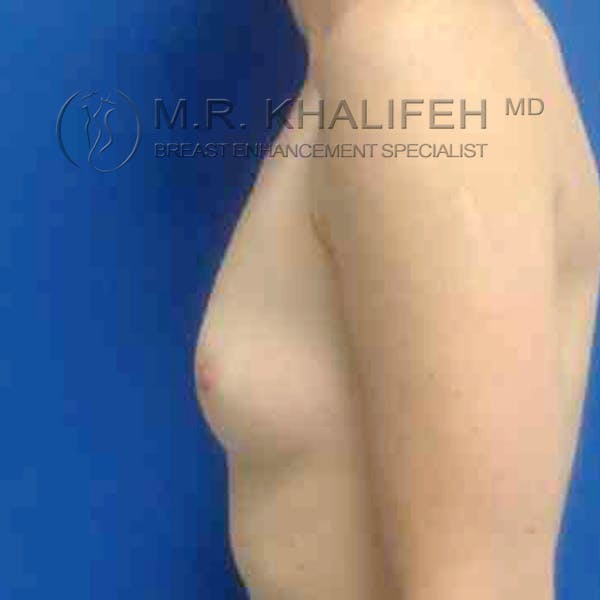 Breast Augmentation Gallery - Patient 3762193 - Image 5