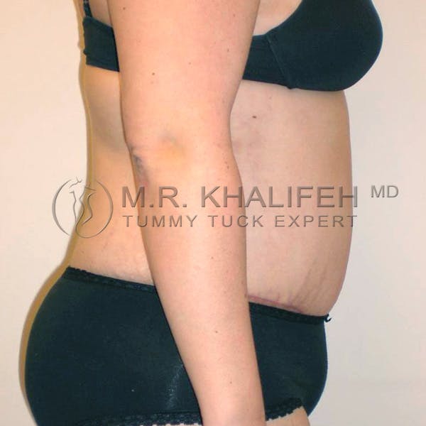Tummy Tuck Gallery - Patient 3762202 - Image 4