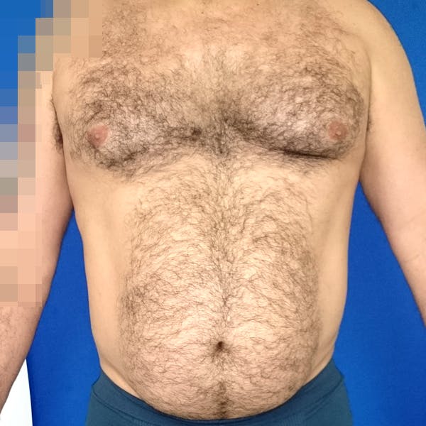 Male Liposuction Gallery - Patient 3762203 - Image 6