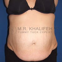 Tummy Tuck Gallery - Patient 3762202 - Image 1