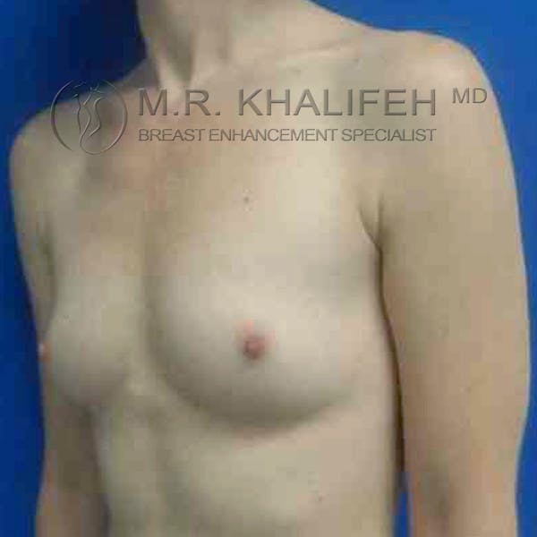 Breast Augmentation Gallery - Patient 3762193 - Image 7