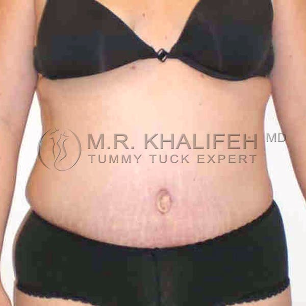 Tummy Tuck Gallery - Patient 3762202 - Image 2
