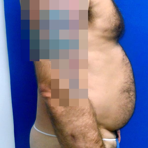 Male Liposuction Gallery - Patient 3762203 - Image 9