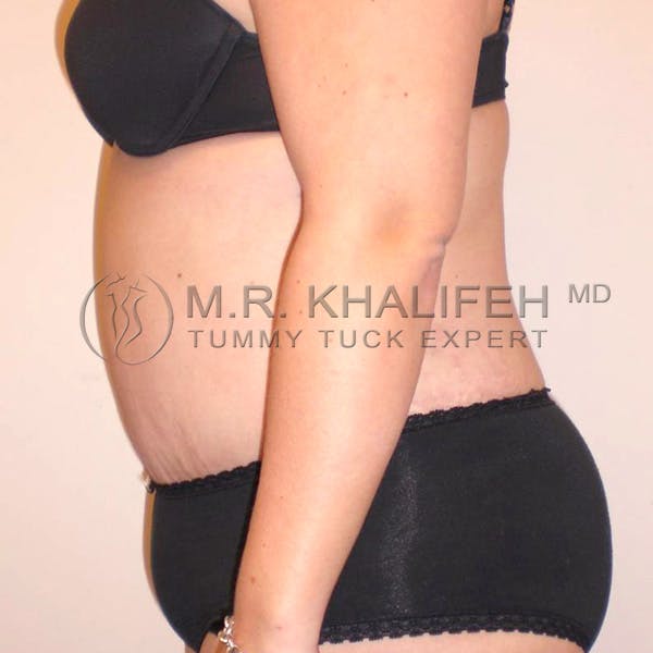 Tummy Tuck Gallery - Patient 3762202 - Image 6