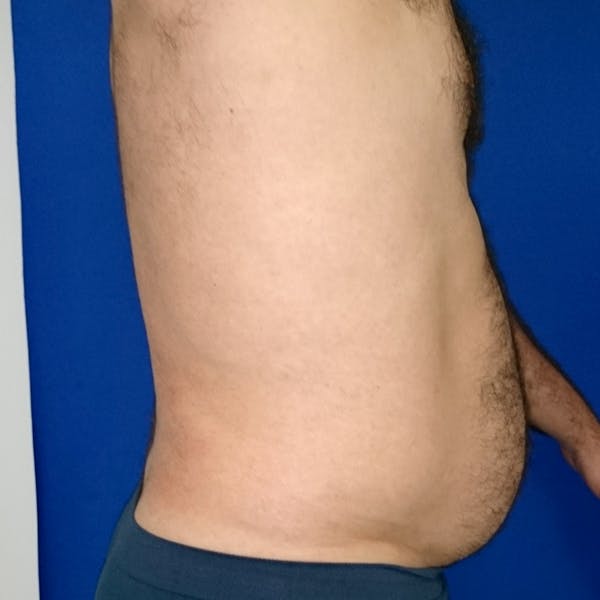 Male Liposuction Gallery - Patient 3762203 - Image 10