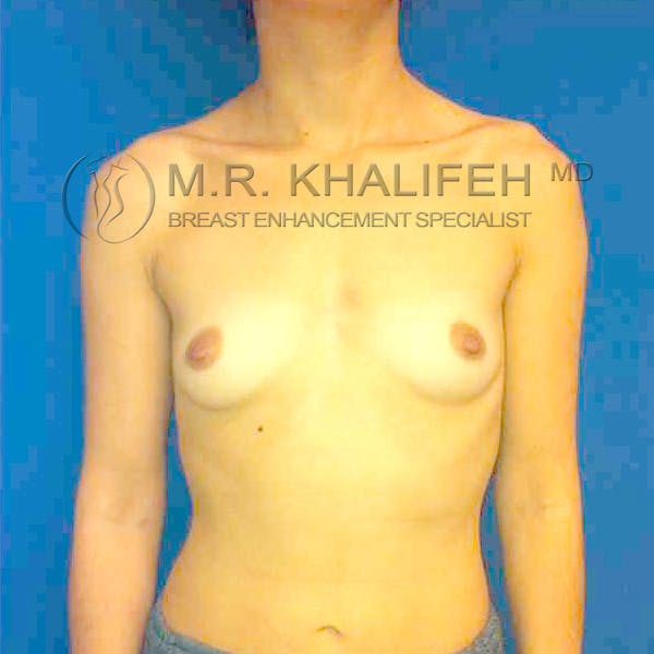 Breast Augmentation Gallery - Patient 3762214 - Image 1