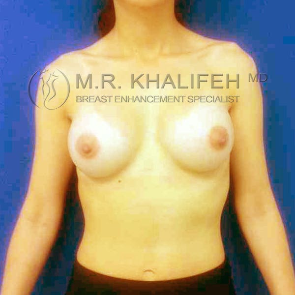 Breast Augmentation Gallery - Patient 3762214 - Image 2