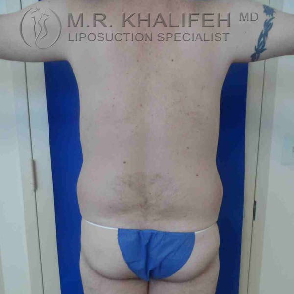 Male Liposuction Gallery - Patient 3762218 - Image 1