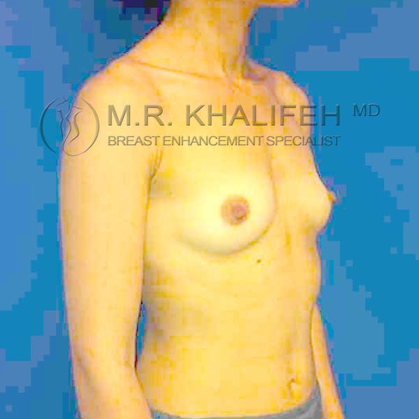 Breast Augmentation Gallery - Patient 3762214 - Image 5