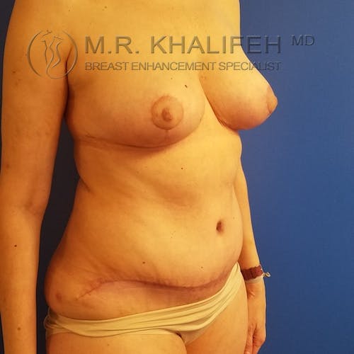 Breast Lift Gallery - Patient 3762220 - Image 4