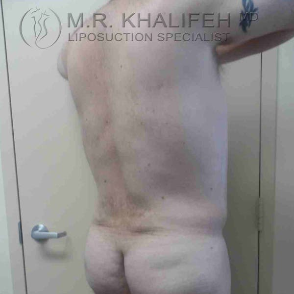 Male Liposuction Gallery - Patient 3762218 - Image 4