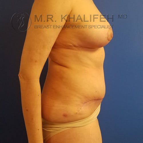 Breast Lift Gallery - Patient 3762220 - Image 6
