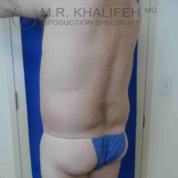 Male Liposuction Gallery - Patient 3762218 - Image 5