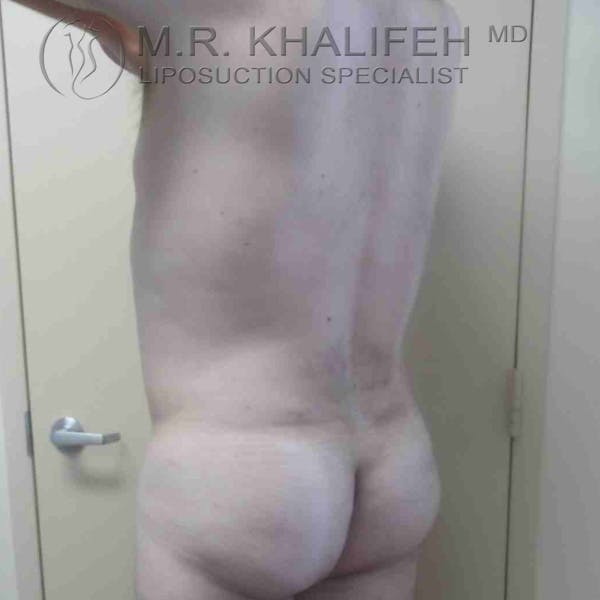 Male Liposuction Gallery - Patient 3762218 - Image 6